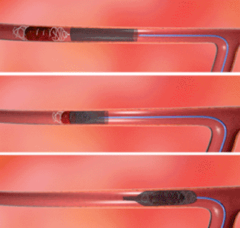 Imagen: El dispositivo de trombectomía ReCover, en acción (Fotografía cortesía de Lazarus Effect).